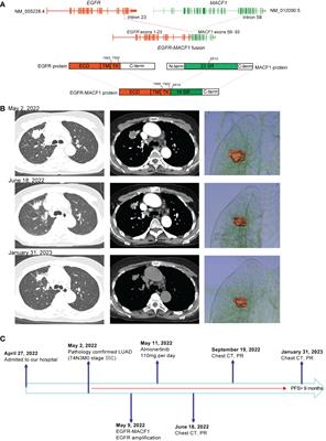 Case report: EGFR fusion mutation combined with EGFR amplification responds to EGFR-TKI therapy